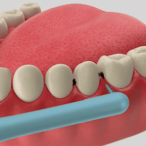 Guide Between Teeth